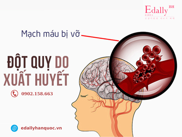 Xuất huyết não là nguyên nhân gây tai biến mạch máu não