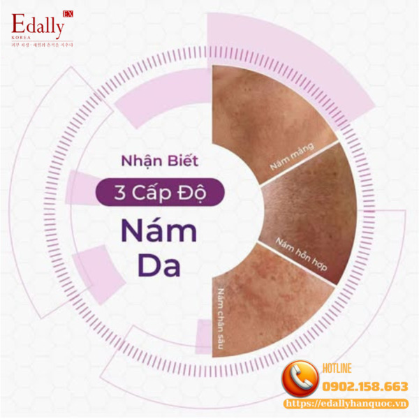 3 cấp độ của nám da