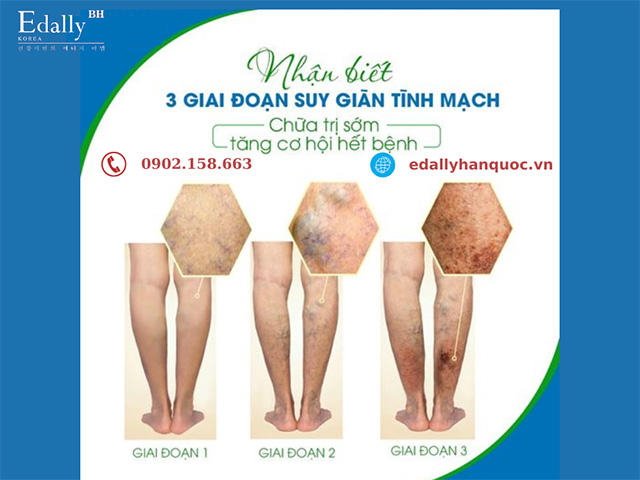 3 giai đoạn tiến triển của bệnh suy giãn tĩnh mạch