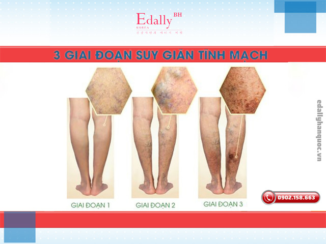 3 giai đoạn tiến triển của suy giãn tĩnh mạch