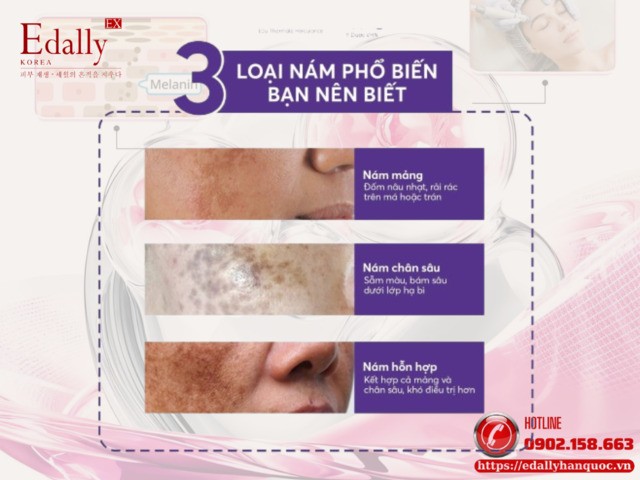 3 loại nám da mà bạn nên biết