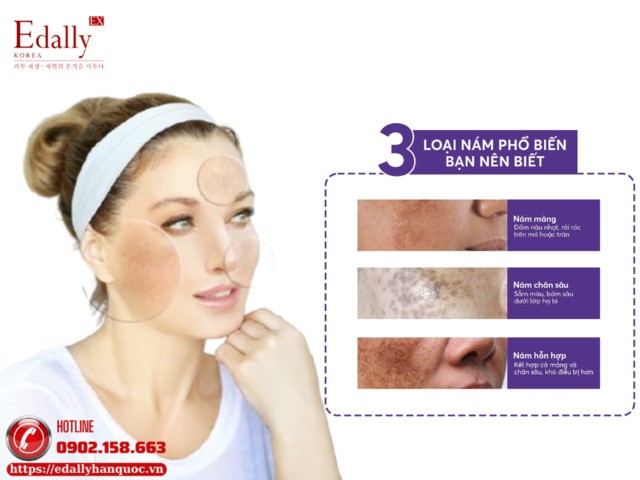 3 loại nám da phổ biến mà bạn nên biết