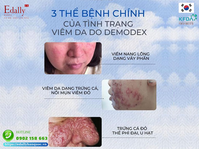 3 thể bệnh chính của tình trạng viêm da do Demodex