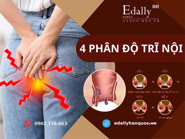 Các phân độ của bệnh trĩ nội