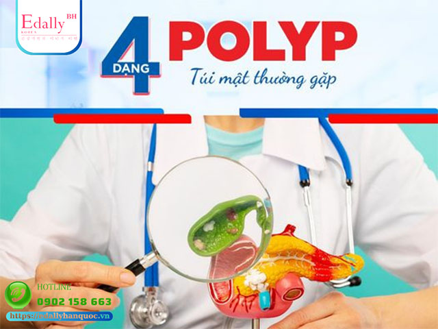 4 dạng polyp túi mật thường gặp