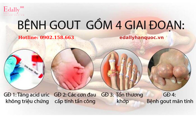 4 giai đoạn của bệnh gout