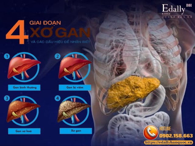 4 giai đoạn của bệnh xơ gan và dấu hiệu để nhận biết