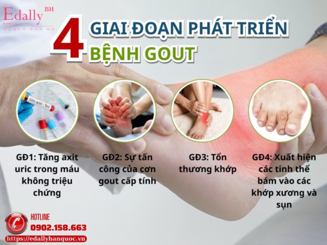 4 giai đoạn tiến triển của bệnh gout