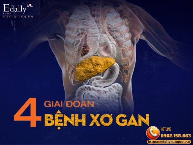 4 giai đoạn tiến triển của xơ gan - Nhận biết để phòng ngừa và điều trị từ sớm