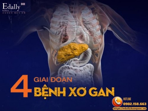 4 Giai Đoạn Của Xơ Gan