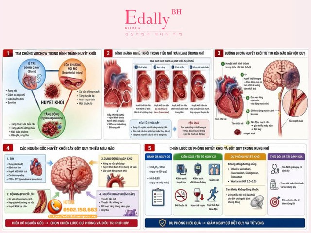 Huyết khối và đột quỵ: Từ cơ chế bệnh sinh đến chiến lược dự phòng trong thực hành tim mạch học
