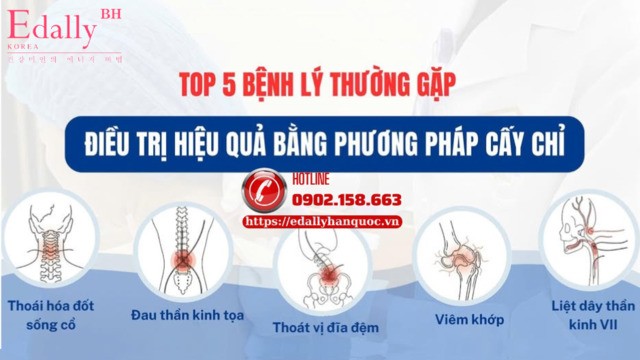 Top 5 bệnh lý thường gặp điều trị hiệu quả bằng phương pháp cấy chỉ