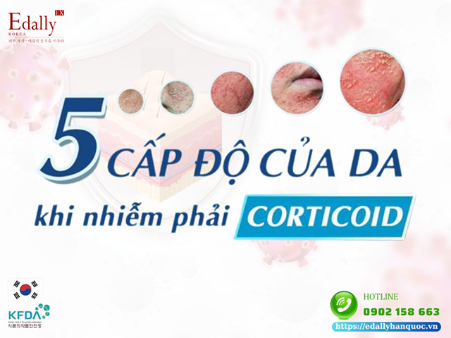 5 cấp độ của da khi nhiễm phải Corticoid