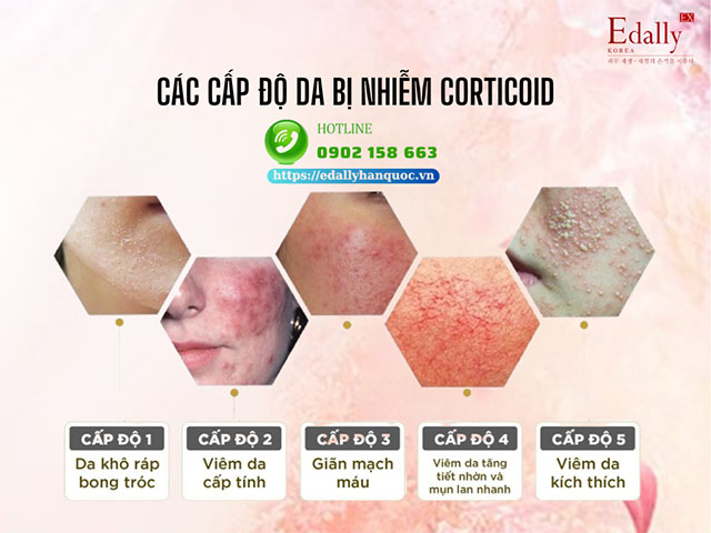 5 cấp độ da nhiễm Corticoid do sử dụng Mỹ phẩm chứa Corticoid