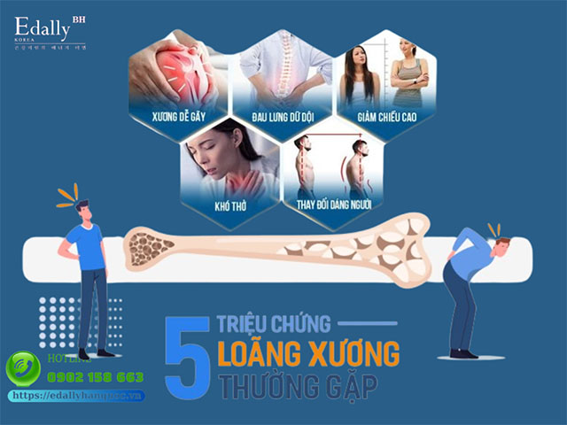 5 dấu hiệu điển hình của bệnh loãng xương