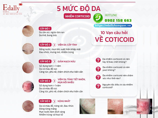 Corticoid không xấu nhưng nếu lạm dụng bôi thoa sẽ  khiến da bị nhiễm Corticoid