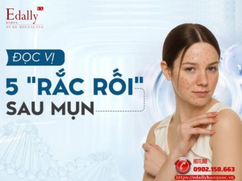 Đọc Vị 5 Rắc Rối Sau Mụn Thường Gặp Và Cách Xử Lý