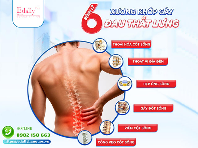 6 bệnh lý cơ xương khớp gây đau thắt lưng