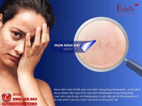 Fungal acne - Da Nhiễm Nấm Men, Viêm Da Tiết Bã, Viêm Nang Lông