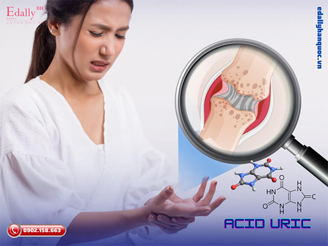 Mối liên hệ giữa Acid uric và bệnh gout