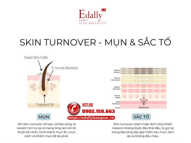 Ảnh hưởng của rối loạn chu trình tái tạo da (skin turnover) lên mụn và sắc tố da