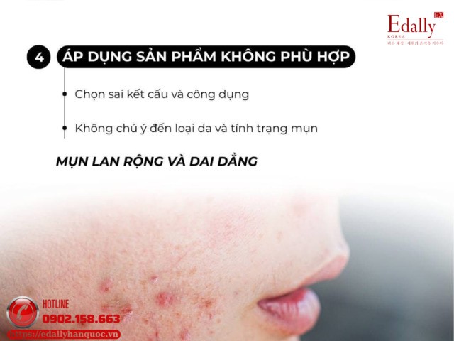 Dùng sản phẩm không phù hợp với tình trạng da khi kết hợp sản phẩm trị mụn khiến mụn ngày càng tệ hơn