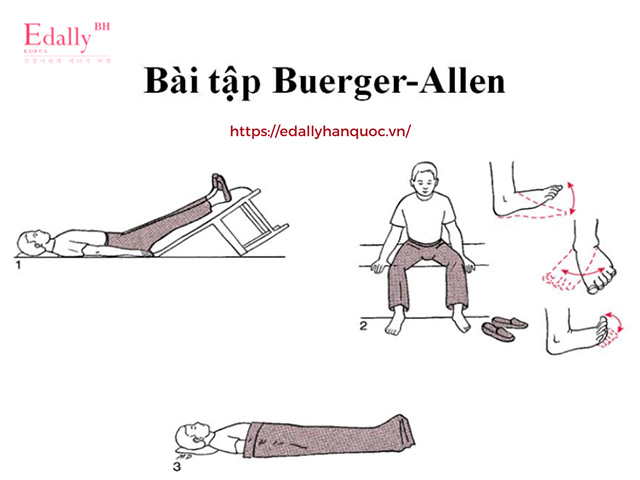 Bài tập Buerger Allen cho người bị suy giãn tĩnh mạch chi dưới