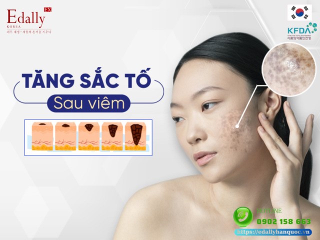 Bạn biết gì về tăng sắc tố da sau viêm (PIH)?