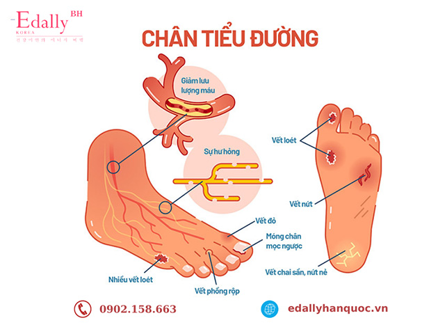 Bàn chân của bệnh nhân đái tháo đường