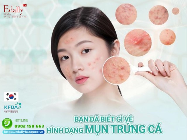 Bạn đã biết gì về các hình dạng của mụn trứng cá?