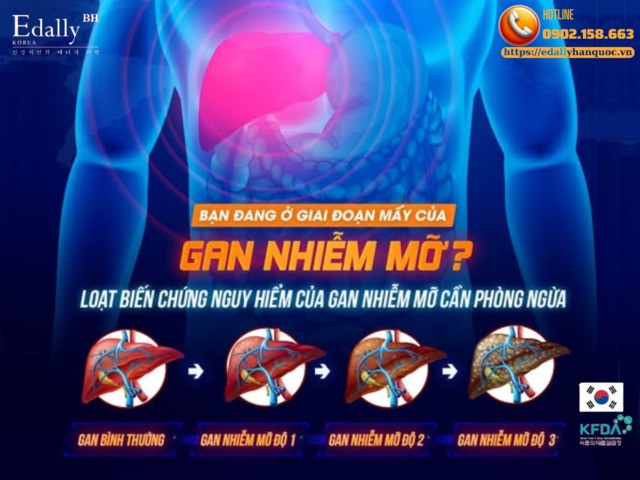 Bạn đang bị gan nhiễm mỡ ở cấp độ mấy?