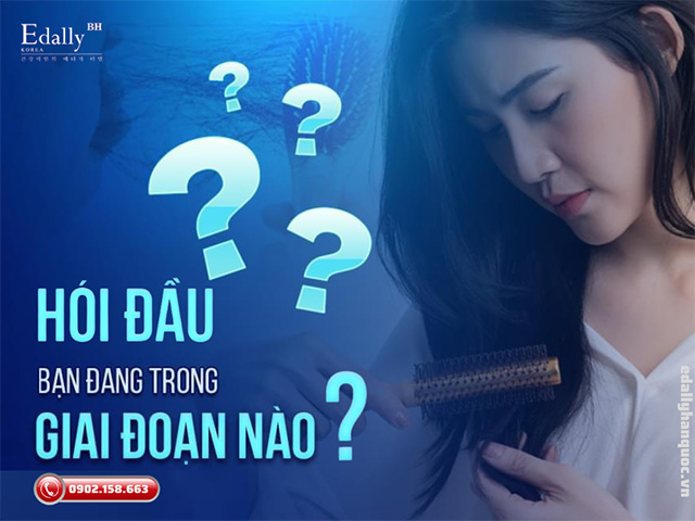 Bạn đang ở giai đoạn nào của chứng hói đầu?