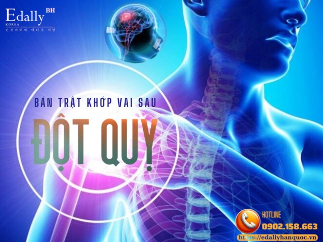 Bán Trật Khớp Vai Sau Đột Quỵ Người Bệnh Cần Lưu Ý Gì?