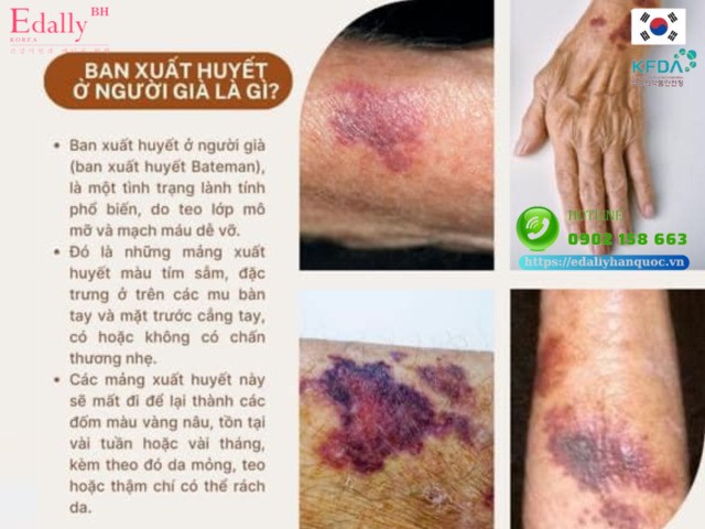 Ban xuất huyết ở người già là gì?