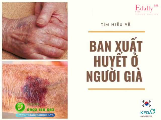 Ban xuất huyết ở người già - Nguyên nhân và cách điều trị hiệu quả