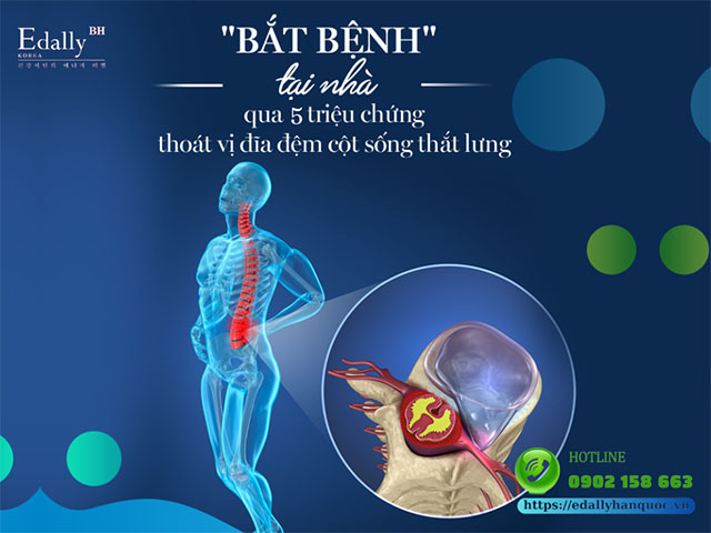 Bắt bệnh tại nhà qua 5 triệu chứng thoát vị đĩa đệm cột sống thắt lưng