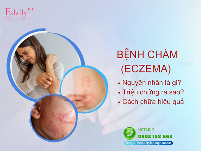 Bệnh chàm - Nguyên nhân, triệu chứng và cách điều trị hiệu quả