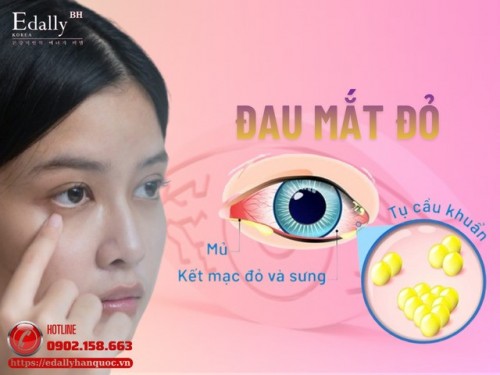 Bệnh Đau Mắt Đỏ - Hiểu Để Phòng Ngừa Và Bảo Vệ Cộng Đồng Bệnh Đau Mắt Đỏ - Hiểu Để Phòng Ngừa Và Bảo Vệ Cộng Đồng