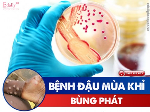 Dấu Hiệu Nhận Biết Và Cách Phòng Chống Bệnh Đậu Mùa Khỉ