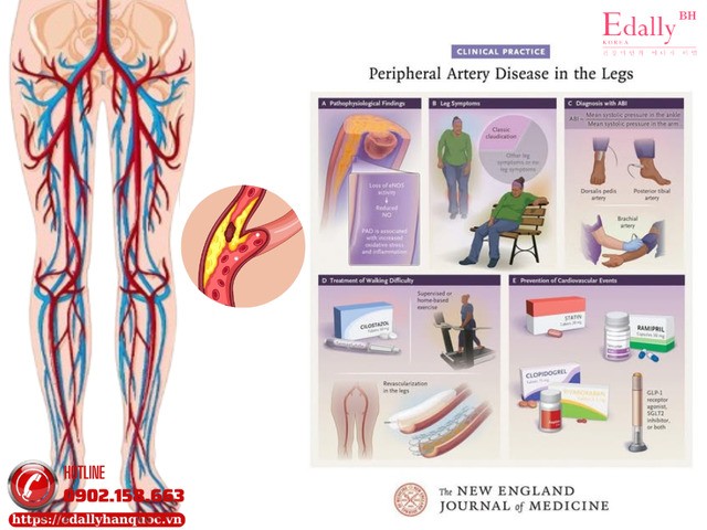 Bệnh động mạch ngoại biên chi dưới (PAD) cập nhật mới nhất 2026
