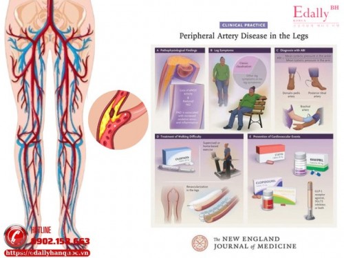 Bệnh Động Mạch Ngoại Biên Chi Dưới (PAD) Cập Nhật Mới Nhất 2026