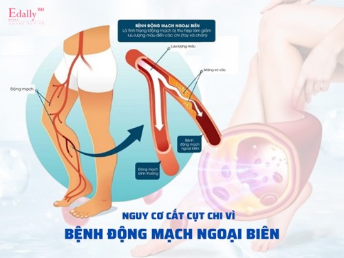 Bệnh Động Mạch Chi Dưới Và Nguy Cơ Cắt Cụt Chi