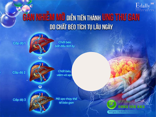 Bệnh gan nhiễm mỡ nguy hiểm như thế nào?