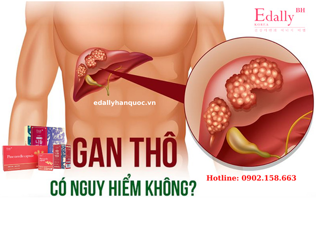 Bệnh gan thô có nguy hiểm không?