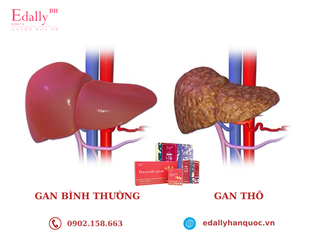 Bệnh gan thô là gì?