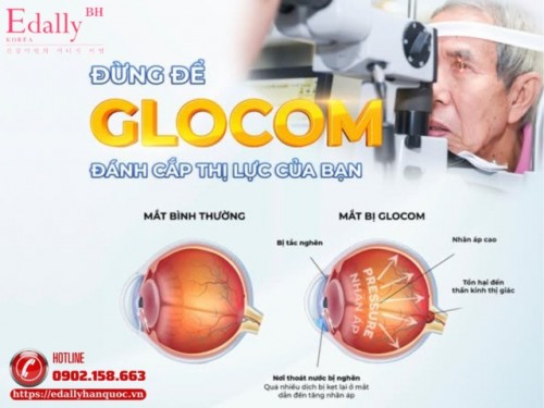 Bệnh Glôcôm - Hiểu Để Dự Phòng 