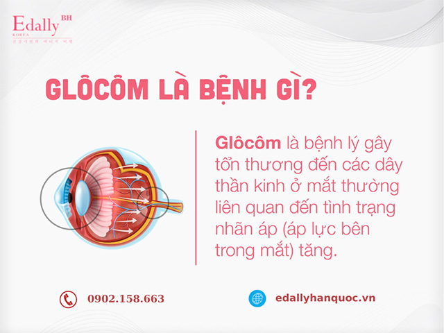 Bệnh Glôcôm là bệnh gì?