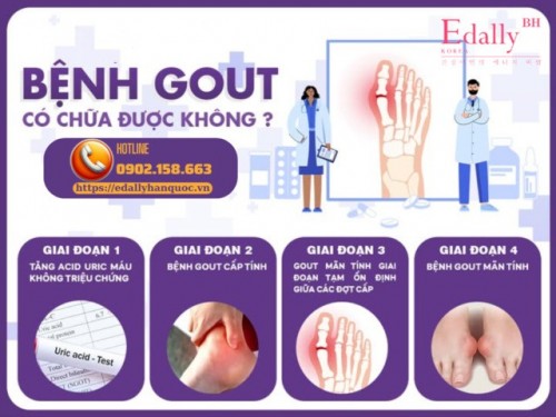4 Giai Đoạn Phát Triển Của Bệnh Gout - Hiểu Rõ Để Kiểm Soát Hiệu Quả
