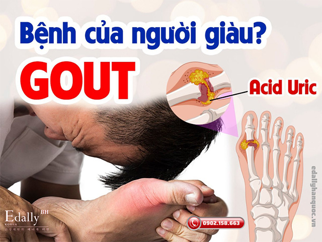 Bệnh Gout không còn là bệnh của người giàu