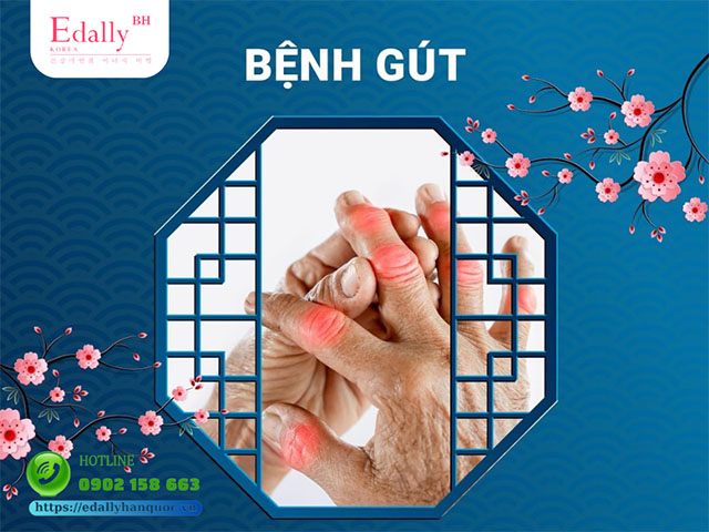 Bệnh gout là căn bệnh thường gặp ngày Tết Nguyên Đán